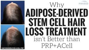 The technicians did a great job following the pattern of my hair and making sure the everything went smooth. Why Adipose Derived Stem Cell Hair Loss Treatment Has No Advantage Over Acell Prp Youtube