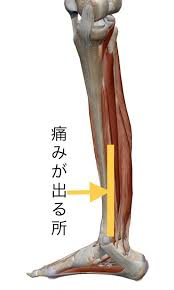 シンスプリント（ＭＴＳＳ）｜共立メディカル 共立総合整骨院｜接骨・整体・鍼灸・マッサージ・交通事故対応・スポーツリハビリ・各種保険取扱