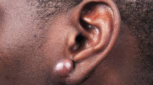 here s why keloid scars form and what