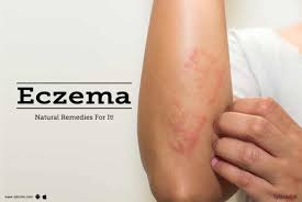 eczema natural remes for it by