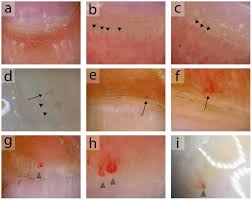 hereditary hemorrhagic telangiectasia