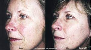 vbeam laser treatments skin