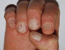 leukonychia what can white nails tell