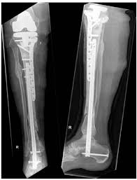 t2 ankle arthrodesis nail