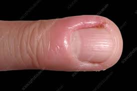 candidiasis around a fingernail stock