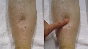 Pitting Edema Causes Scale Treatment And More