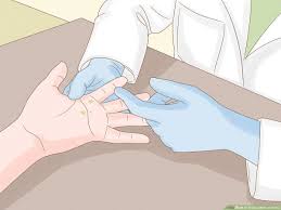 3 ways to treat a wart at home wikihow