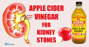 But when i went hunting for studies to support these claims, what i found instead. The Upcoming James Easy Ways To Use Apple Cider Vinegar For Kidney Stones