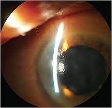 Managing Corneal Lumps And Bumps In The