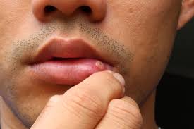 what is a canker sore health channel