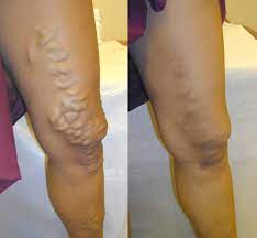 Carriers will cover treatments that are medically necessary. Varicose Vein Treatment Cincinnati Sclerotherapy Springboro
