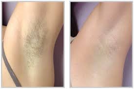 laser hair removal services los angeles