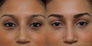 non surgical eyelid lift the cure for