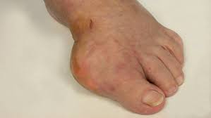 what s wrong with my foot it could be gout