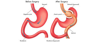 The Pros and Cons to Gastric Bypass Surgery