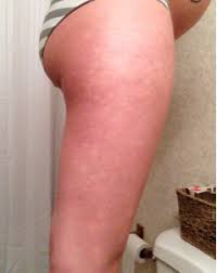 white spots on legs pic april 2016