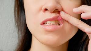 canker sores mouth ulcers and fever