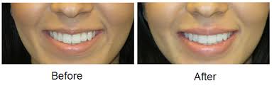 lip enhancement before after pictures