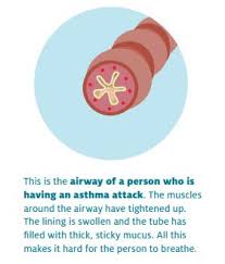 Check spelling or type a new query. Managing Your Child S Asthma Healthed