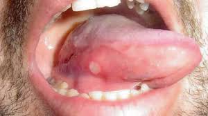 tongue ps 10 potential causes and