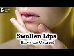 swollen lips common causes triggers
