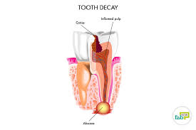 an abscessed tooth