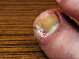 ingrown toenail treatment at md first