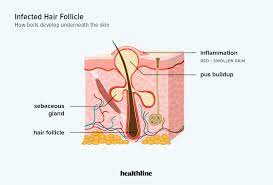 recurring boils causes and treatment