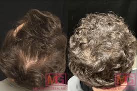 minoxidil for hair loss treatment