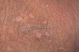pictures of warts hpv where