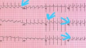 To measure the heart's electrical activity accurately, proper. Cureus Acute Pericarditis And Pericardial Effusion In A Hypertensive Covid 19 Patient