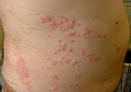 sea lice rash pictures symptomore