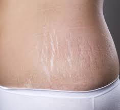 stretch mark removal in vancouver bc