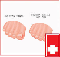 ingrown toenail removal treatments