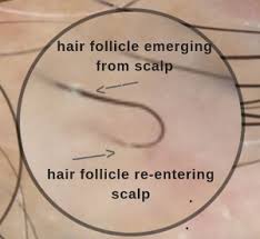 ring alopecia ingrown hair