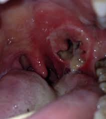 peritonsillar abscess