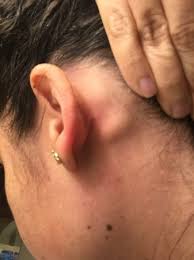 swollen lymph nodes behind left ear