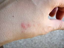bed bug bites pictures treatment and
