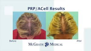 acell prp hair regrowth injection therapy austin houston dallas texas