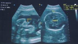 Usg atau ultrasonografi adalah pemeriksaan yang penting melalui usg, dokter dan ibu hamil dapat mengetahui kondisi janin dalam kandungan. Perbedaan Usg Laki Laki Dan Perempuan Artikelkeren Com
