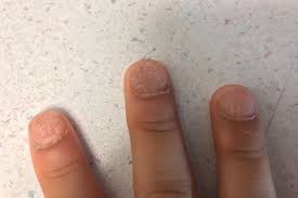 nail dystrophy with ridging and