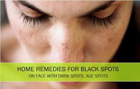 10 best home remes for black spots