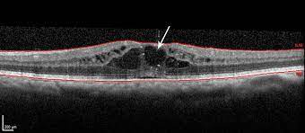 cystoid macular oedema following