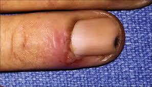 nail changes in autoimmune blistering