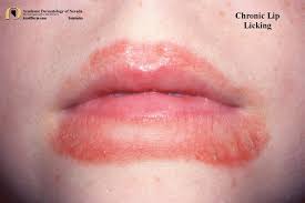 chronic lip licking exfoliative