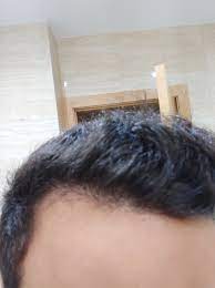 Male pattern baldness is less common among asian and african american men than caucasian men. What S Causing My Diffuse Hair Loss At 16 Quora