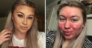 student who covers severe acne with