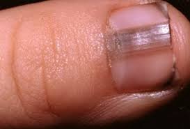 nail mimics toenail fungus