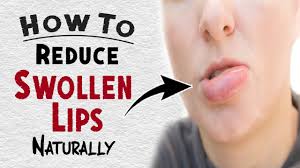 remes for swollen lips treatment