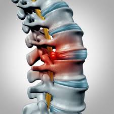 moderate herniated disc at l5 s1